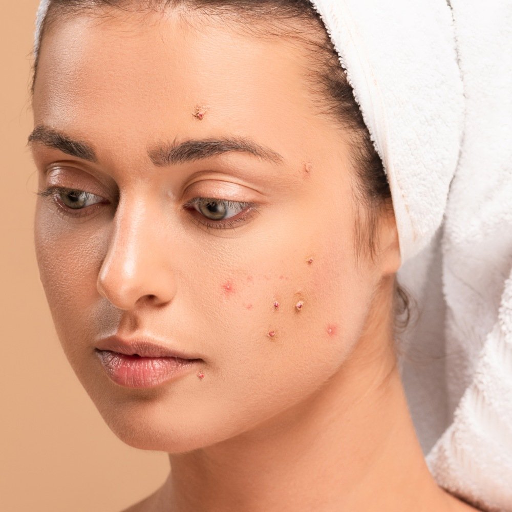 Acne Scars