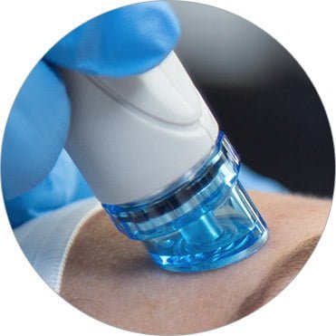 Hydrafacial Vortex Technology