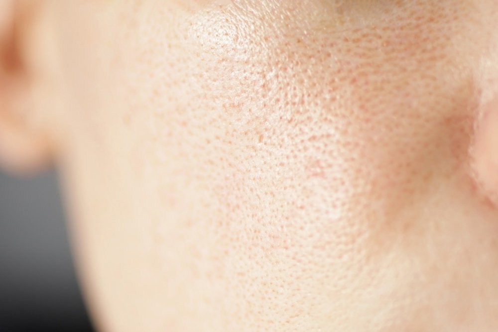 Can MNRF Reduce Open Pores?