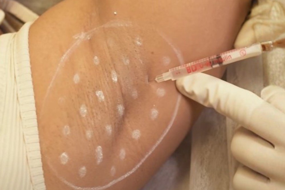 Best Treatment for Underarm Pigmentation and Dark Underarms in Delhi