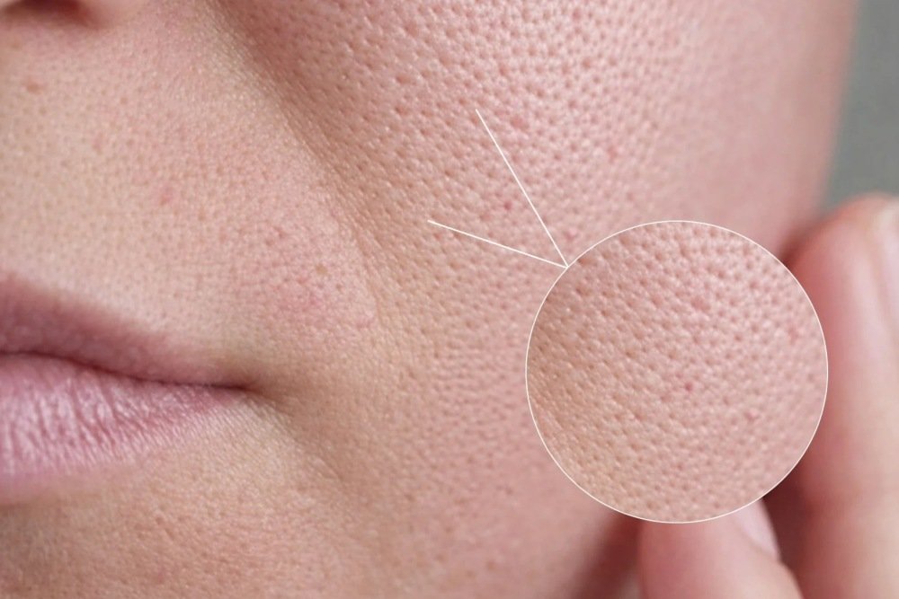 Best Open Pores Treatment in Delhi: Get Smooth, Flawless Skin at Klarity Skin Clinic