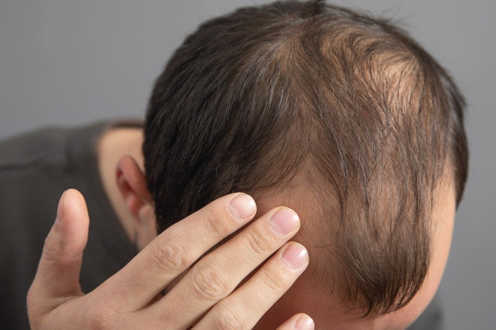 What Is Male Pattern Hair Loss?