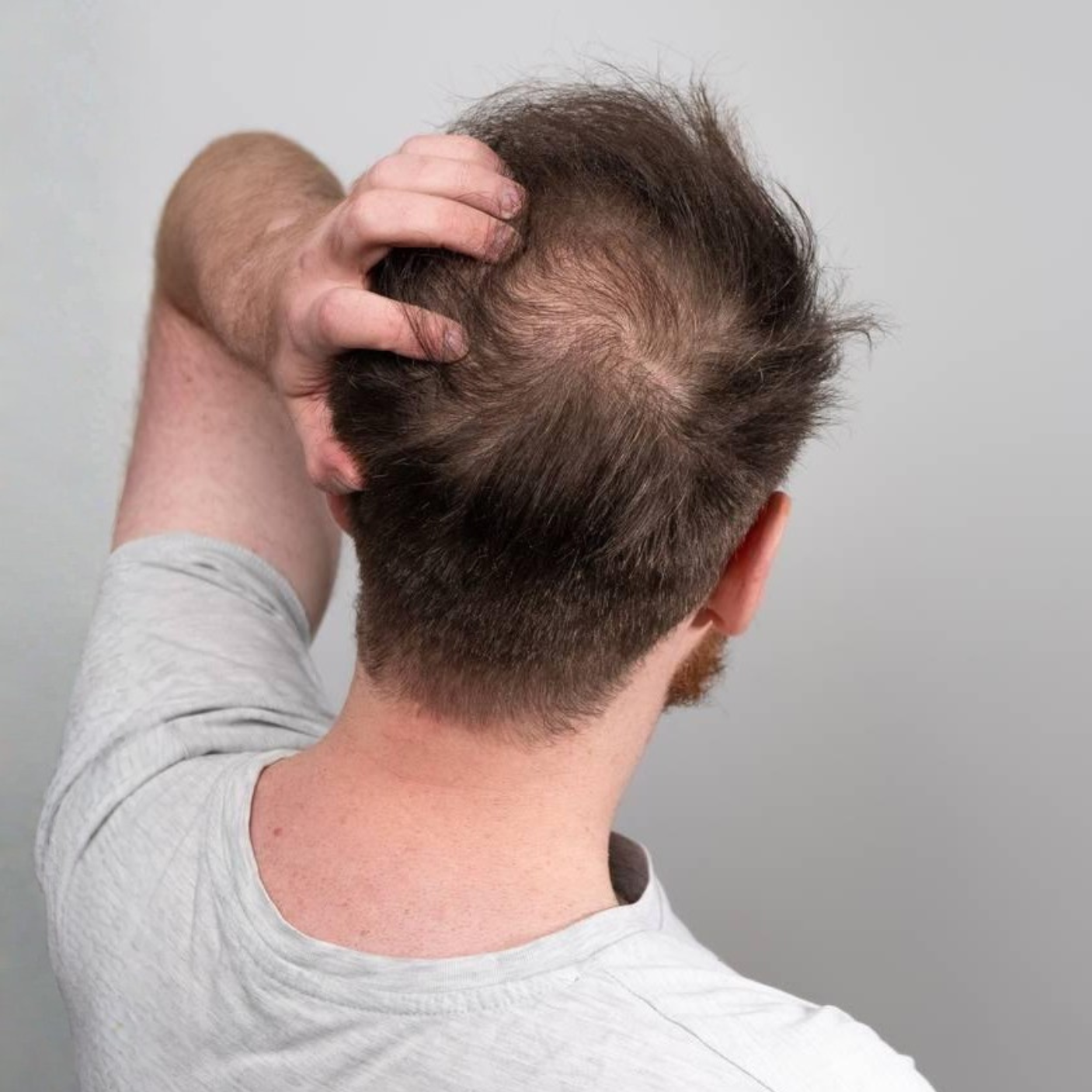 Top Proven Treatments for Male Pattern Hair Loss in 2026
