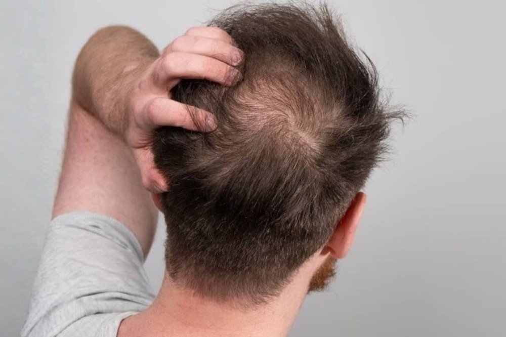 Stages of Male Pattern Hair Loss​