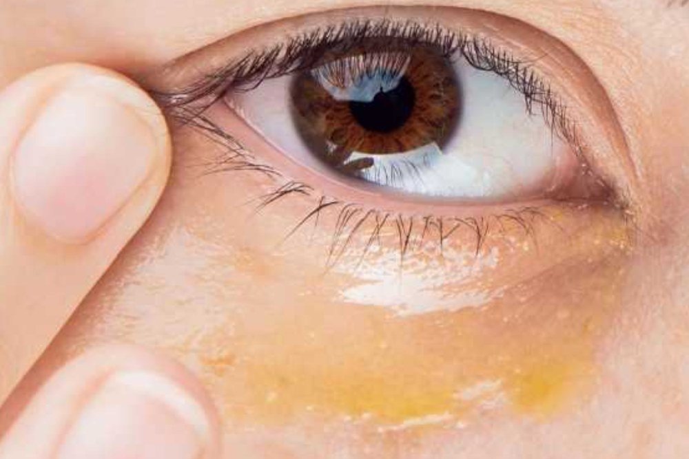 How to Remove Dark Circles Effectively