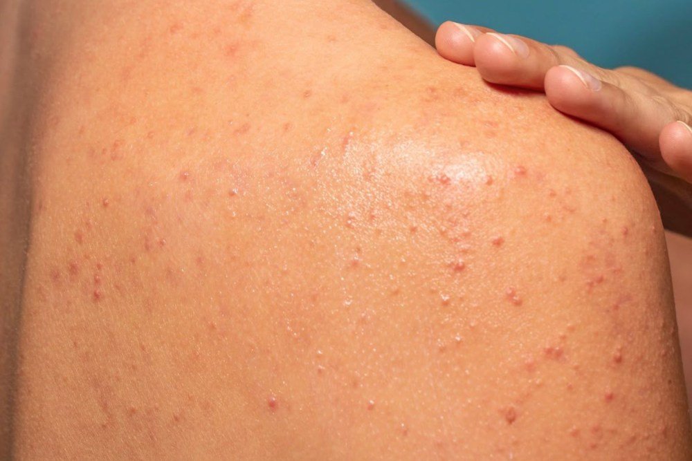 Keratosis Pilaris Treatment in Delhi: Causes, Symptoms & Best Dermatologist Solutions