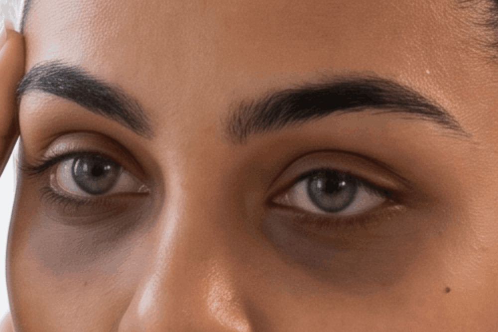 What Causes Ozempic Face?