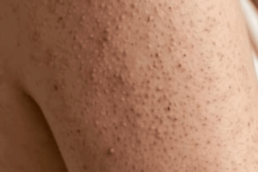What Causes Keratosis Pilaris?