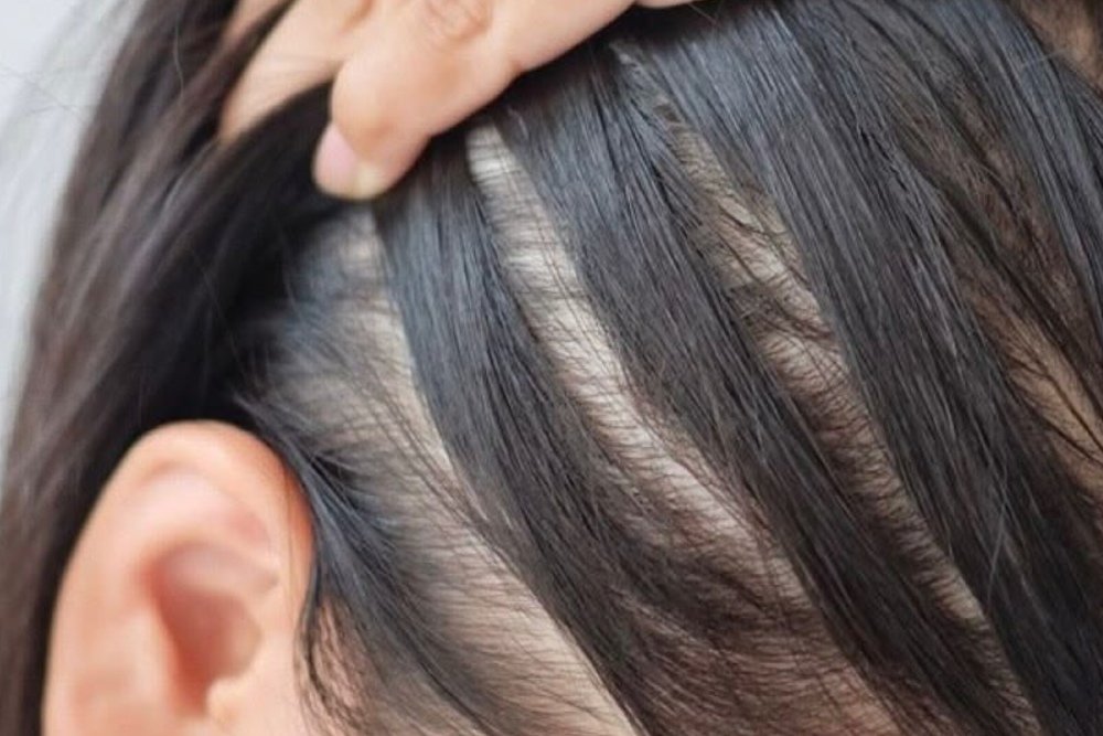 What Is Traction Alopecia?