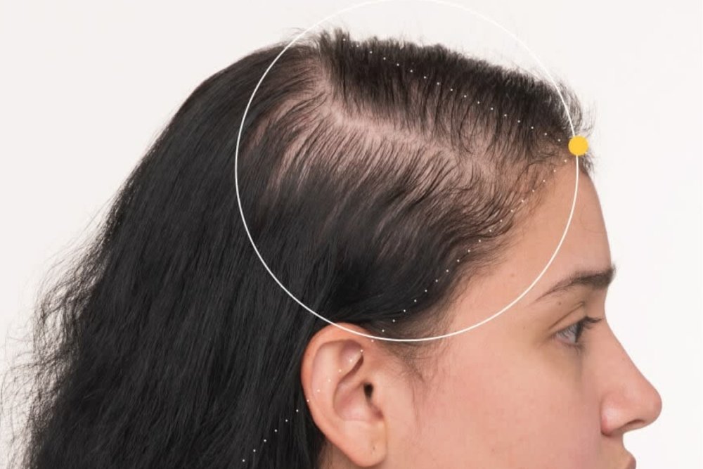 Is Your Hairstyle Causing Hair Loss? Signs of Traction Alopecia