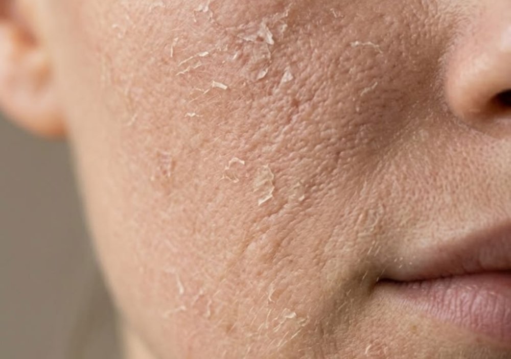 Are You Over-Exfoliating? Signs Your Skin Barrier Is Damaged