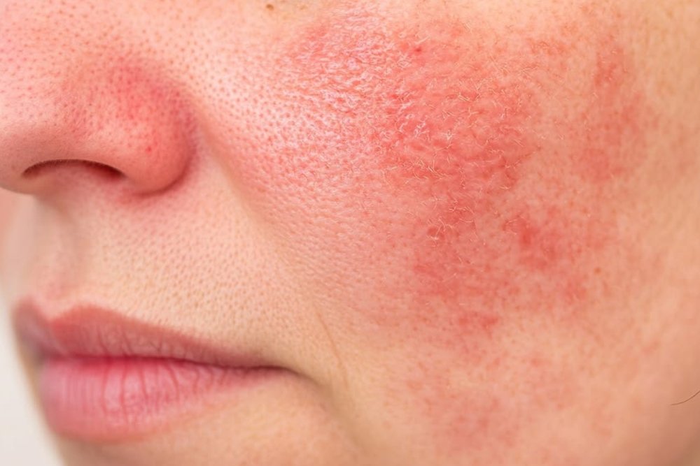 What Does "Over-Exfoliating" Actually Mean?