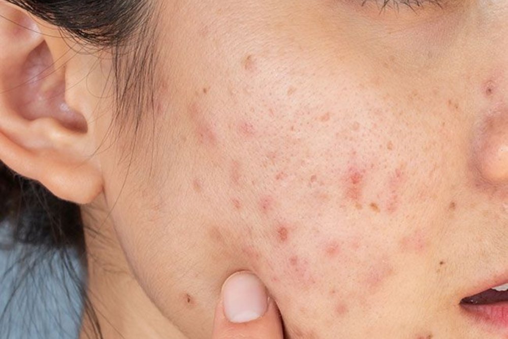 Signs You're Over-Exfoliating