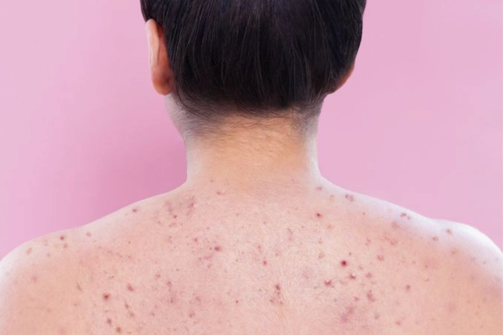 Build a Simple Back Skin Care Routine